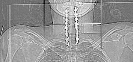 My cervical spine x-ray